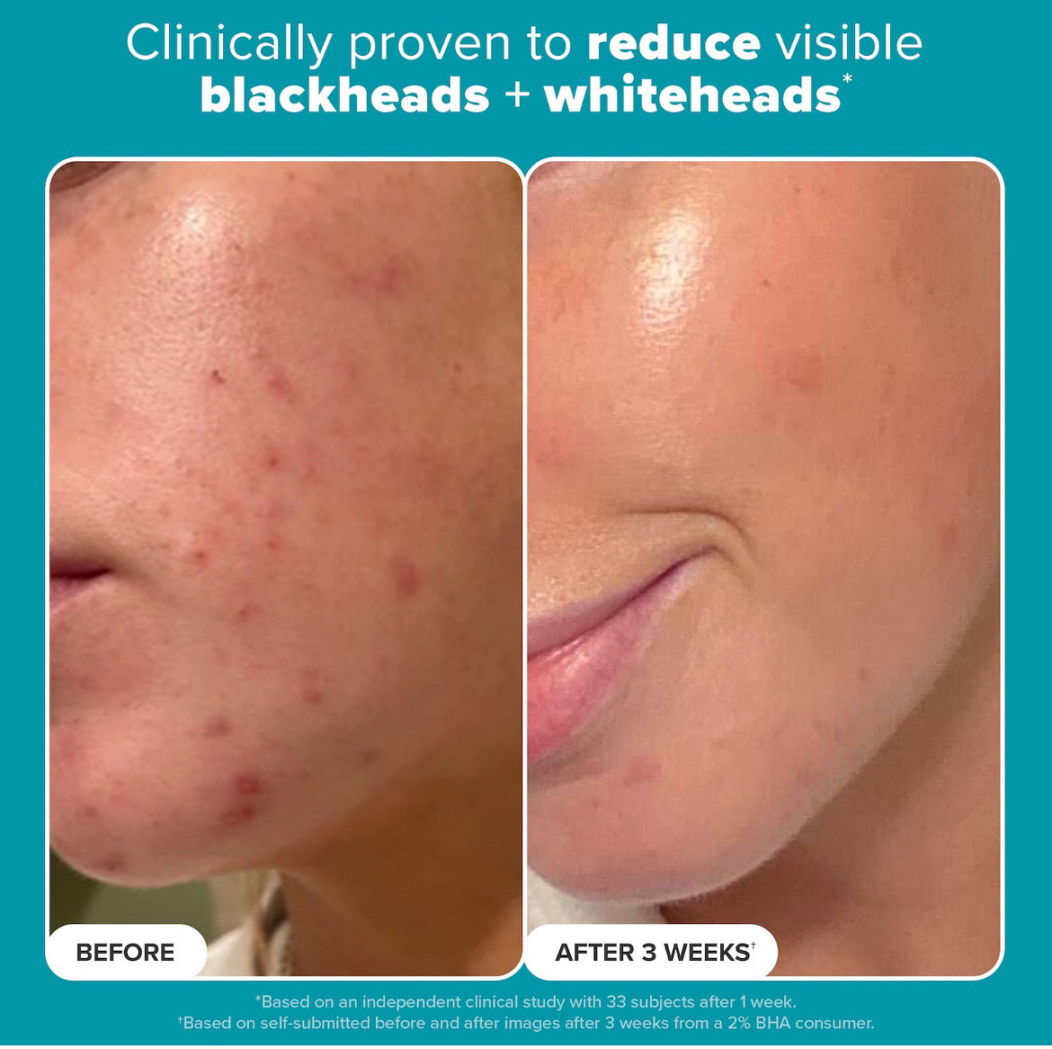 Exfoliante Paula’s Choice